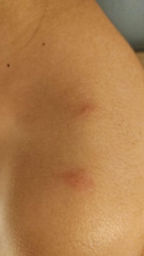 Picadura de chinches en su hotel