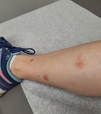 Mystery bug bites from walking dog in grassy areas around hotel