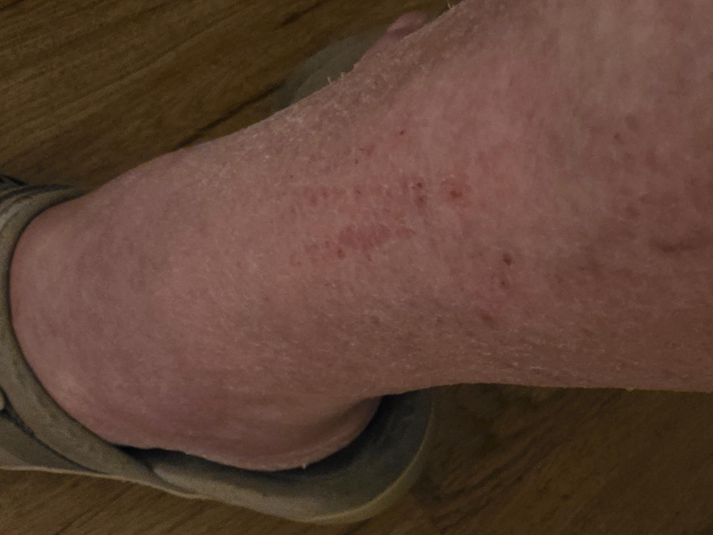 Bedbug bites on the back of my legs