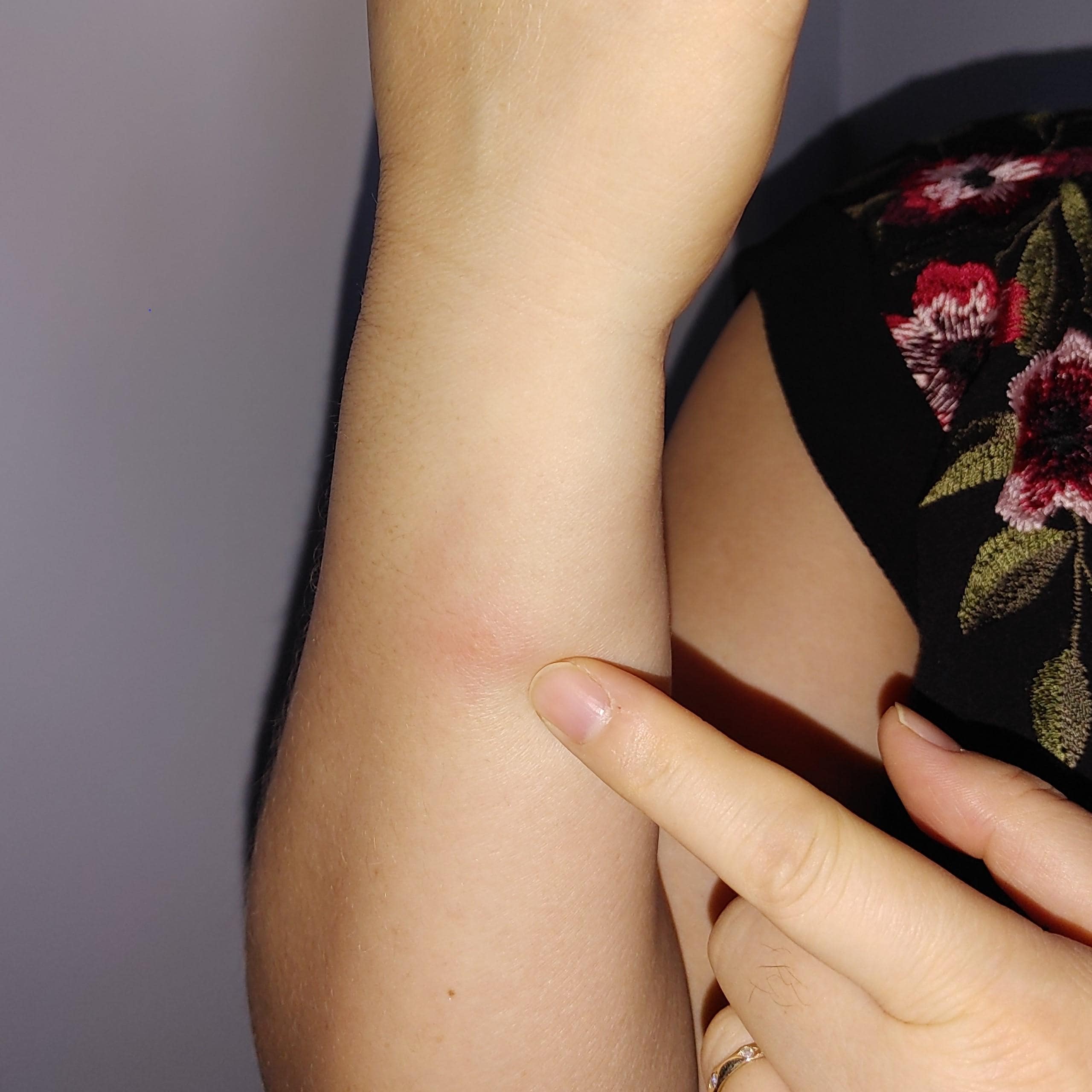 Wife's forearm bitten while sleeping in bed (Sept. 28th, 2025-- #2134- 90 HIGHLAND DRIVE, ORO-MEDONTE , ONTARIO)