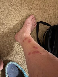 Bed bug bites