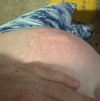 Bites on stomach.
