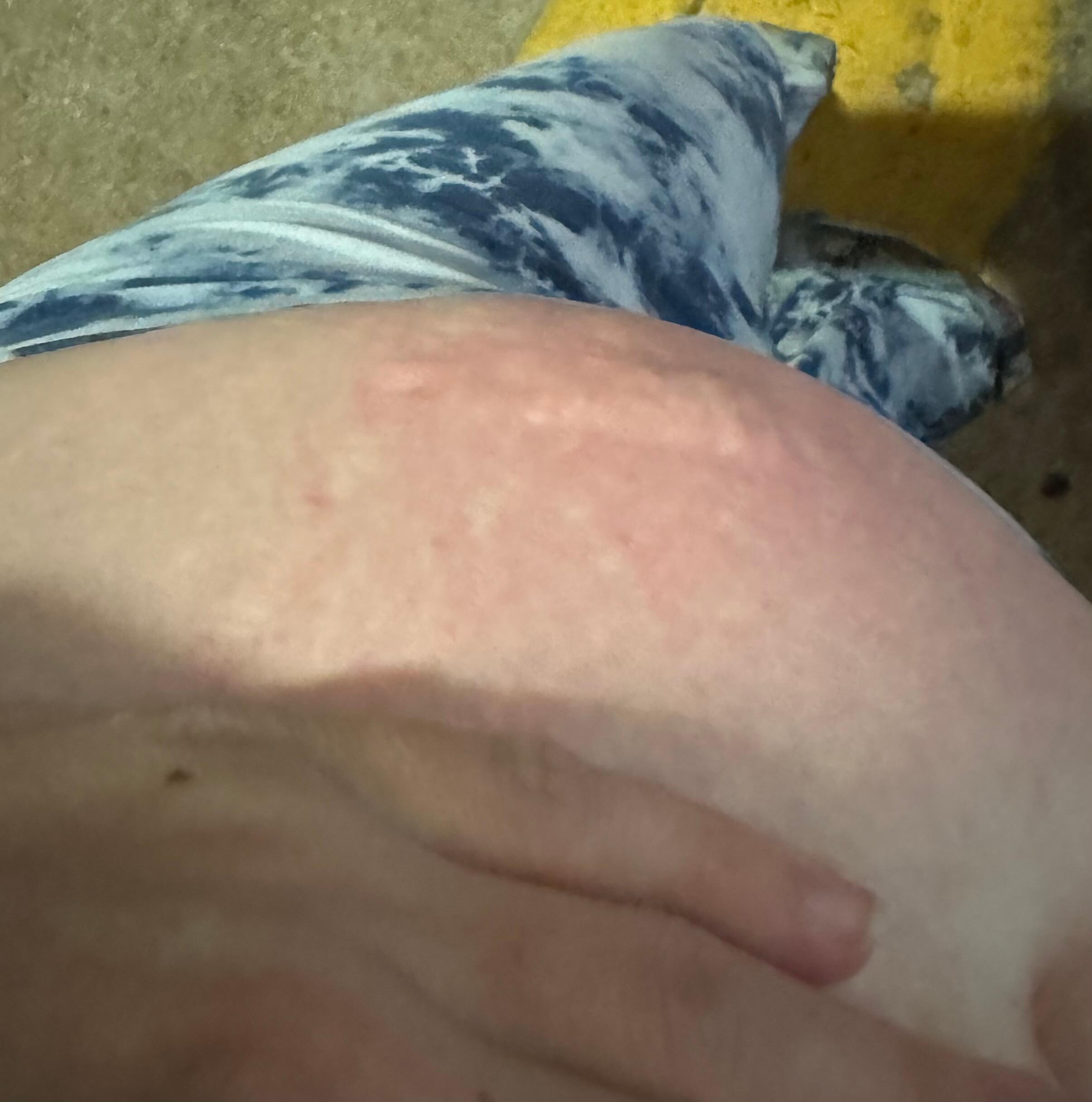 Bites on stomach. 