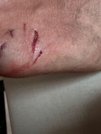 Lesión grave en pie izquierdo causada por un ataque de un animal marino dentro de las instalaciones de hotel