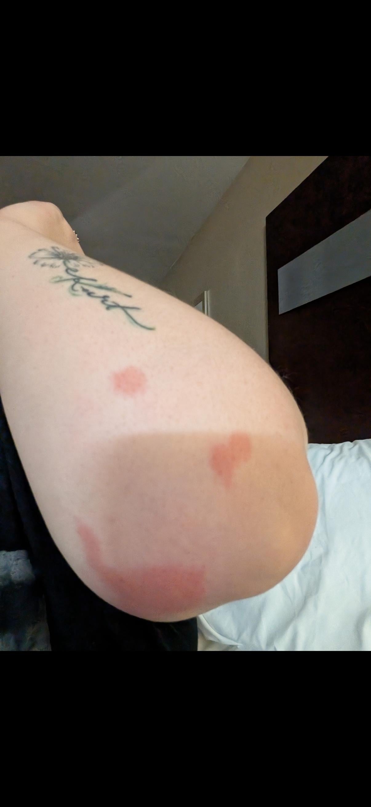 Bed bugs