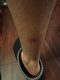 One of three bug bites my nephew got overnight!