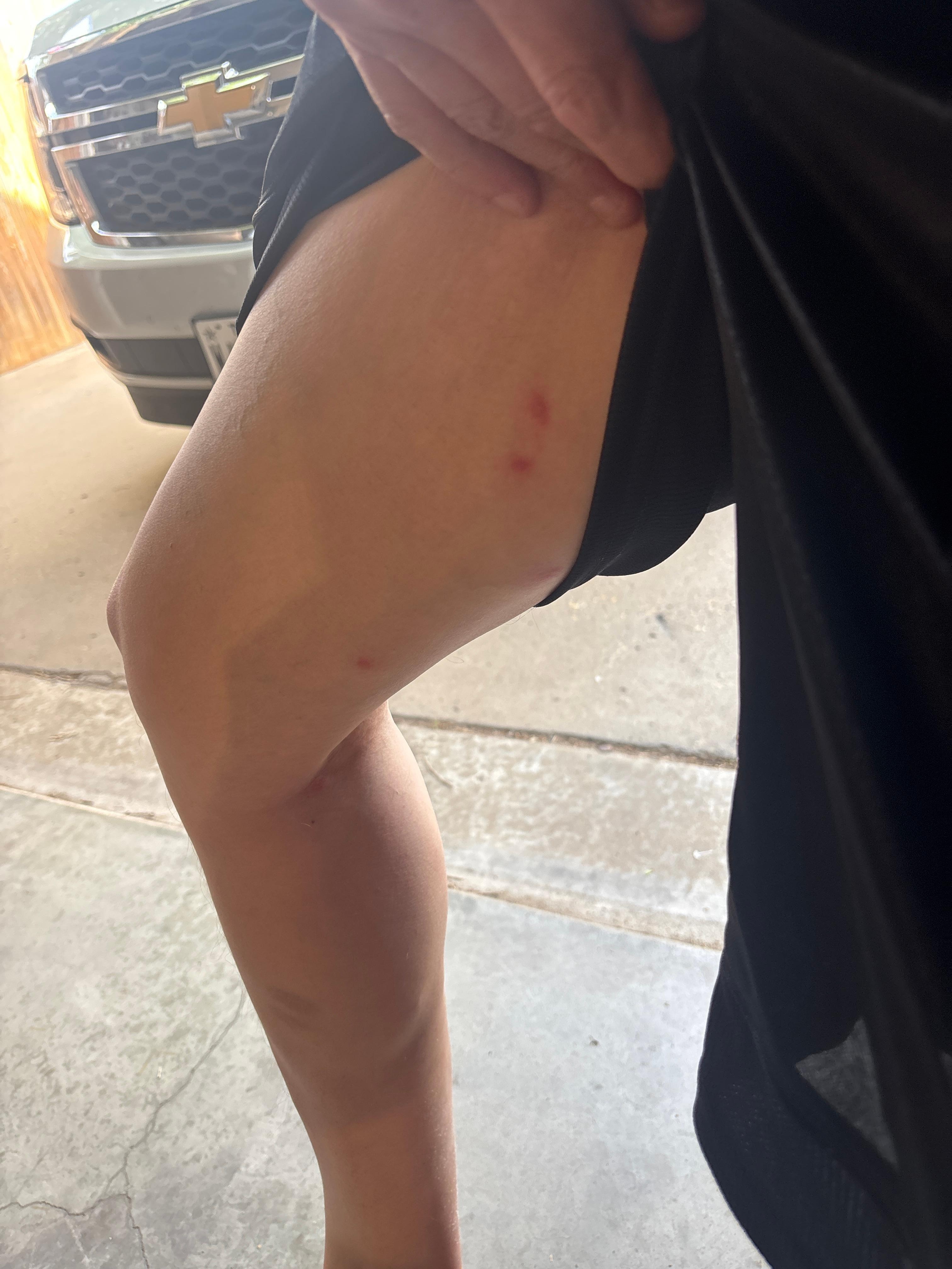 My husbands leg 😢