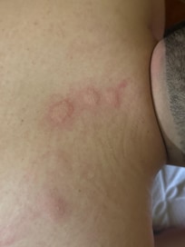 Picaduras a mi novio por estos animales