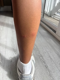 Random bites on his legs after the first night