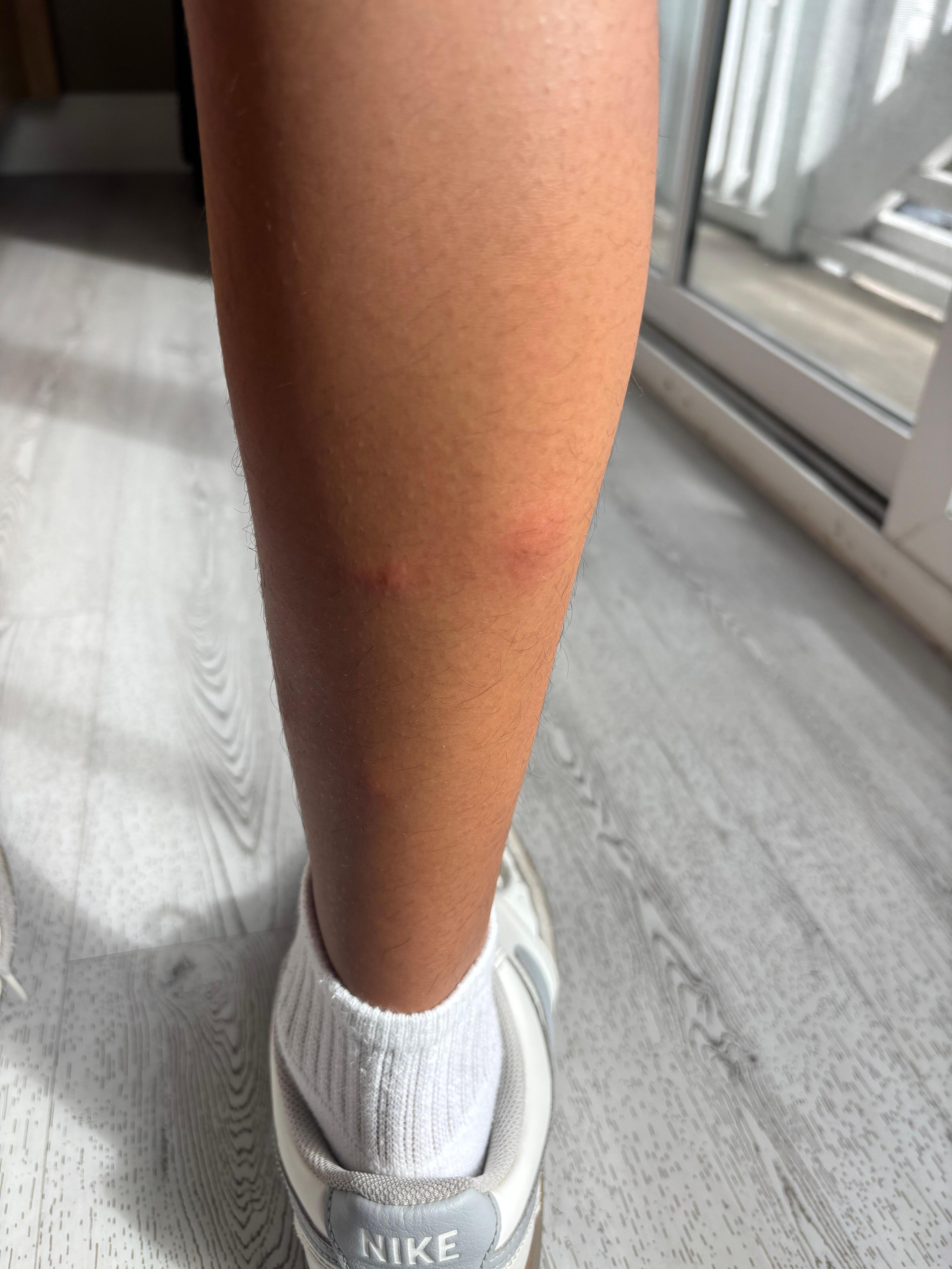 Random bites on his legs after the first night 