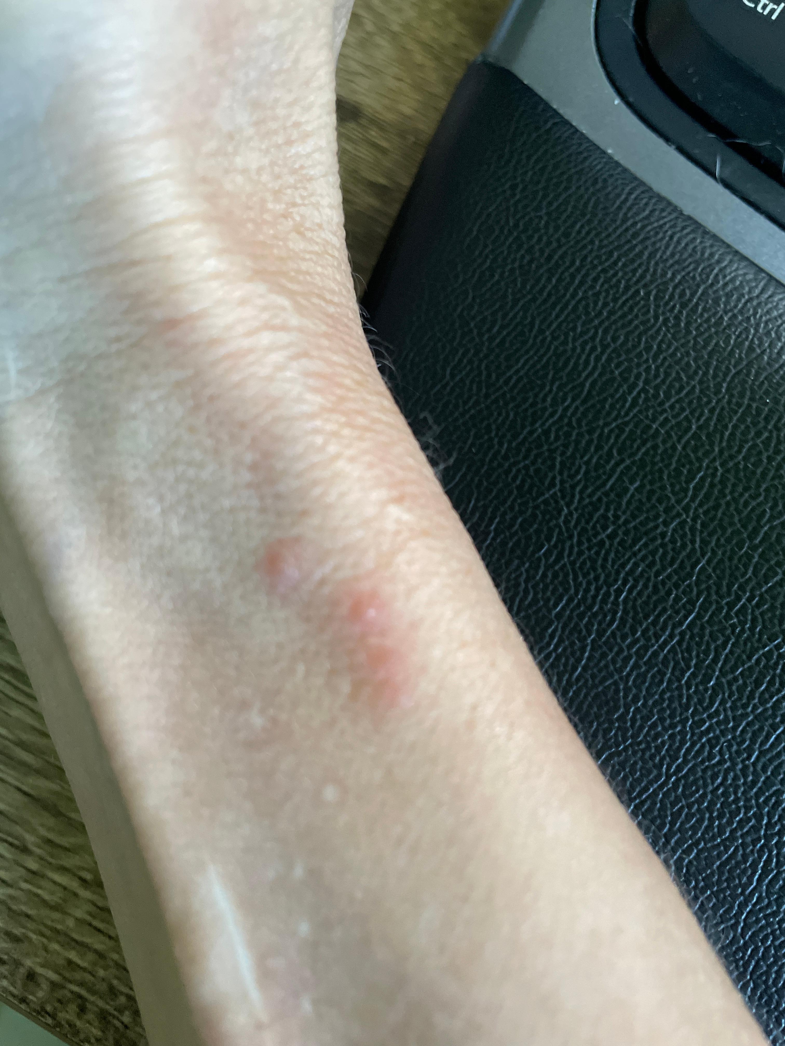 Bed bug bites (there are more)