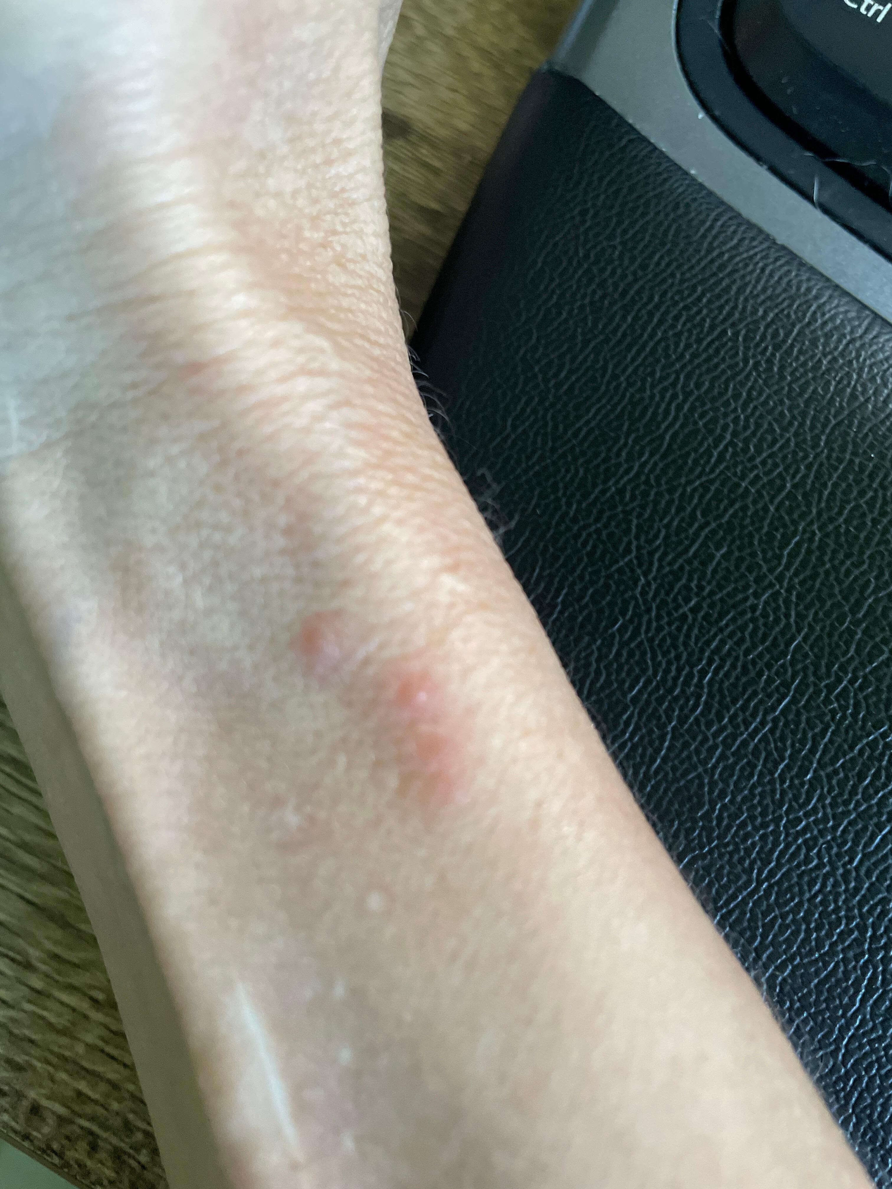 Bed bug bites (there are more)