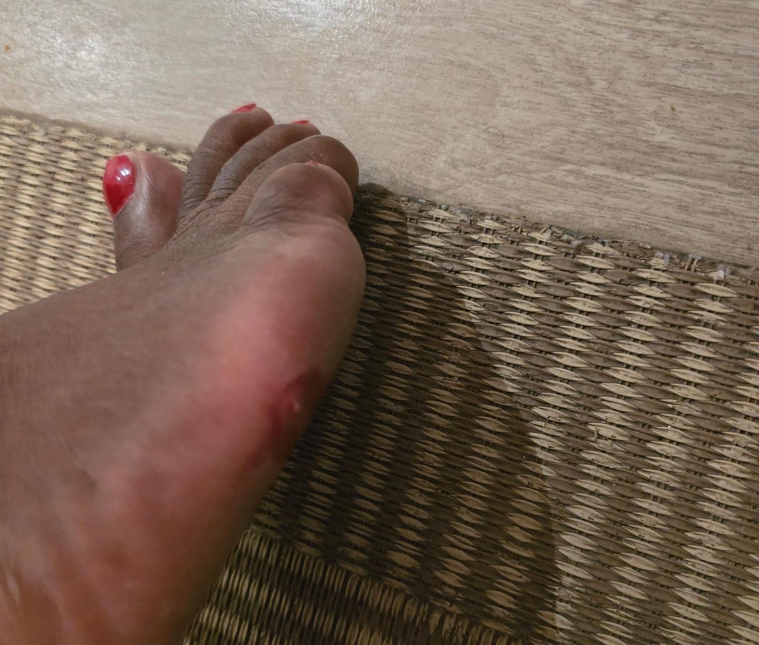 This is what the metal u see did to my foot which went on to become swollen