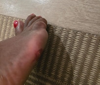 This is what the metal u see did to my foot which went on to become swollen