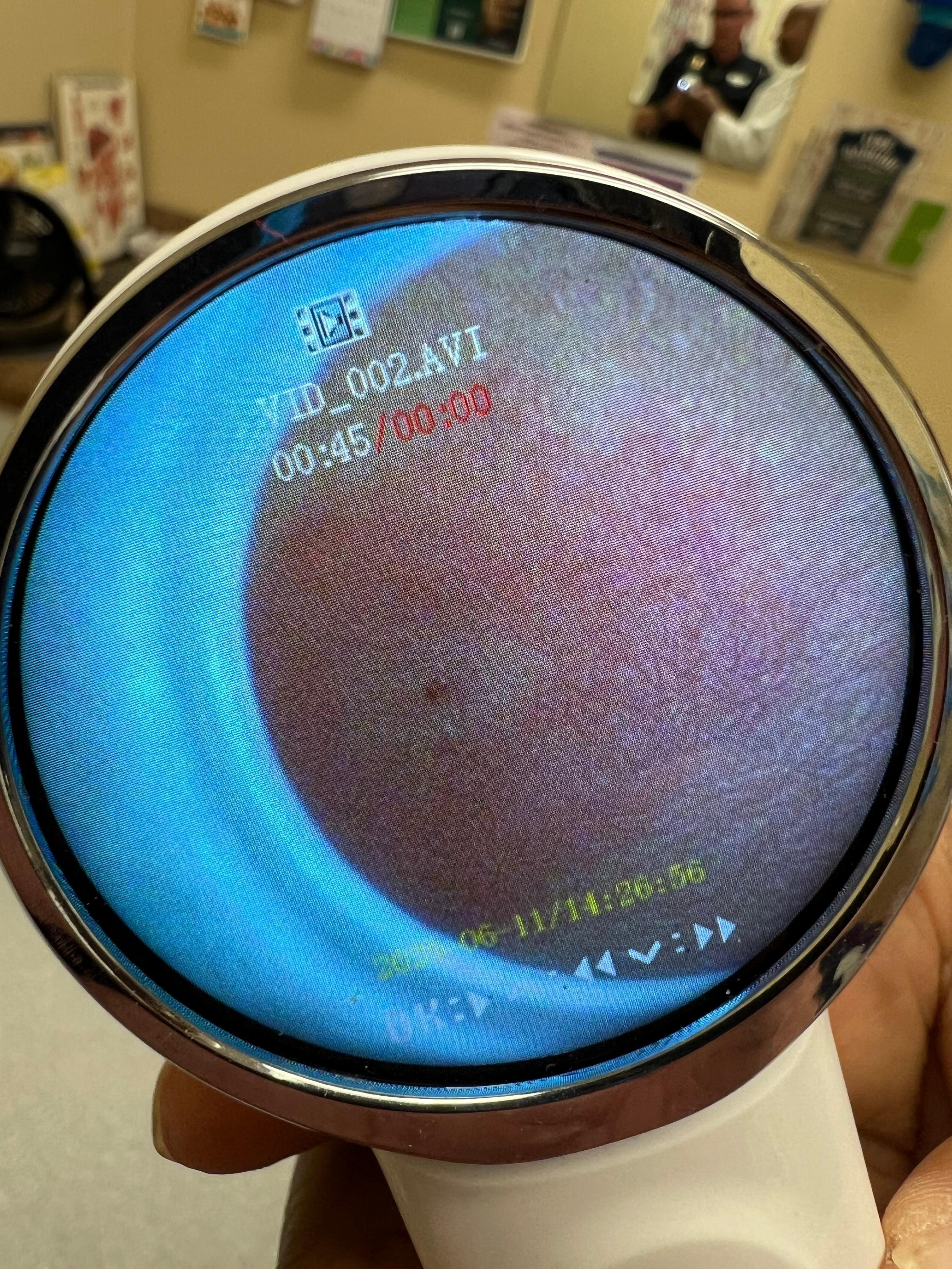 This was taken at the doctor's office where he determined they were bed bug bites.