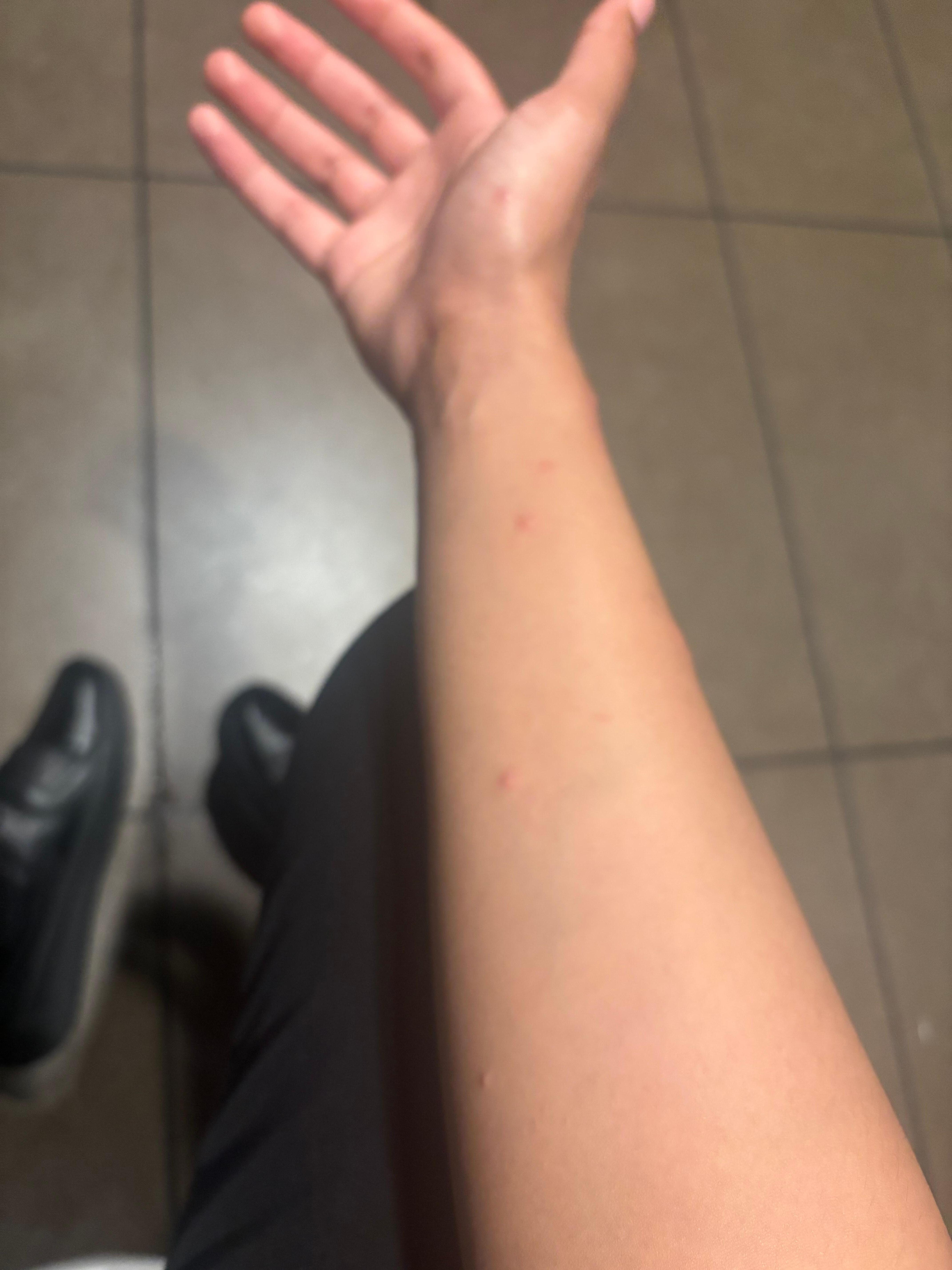 Bed bug bites