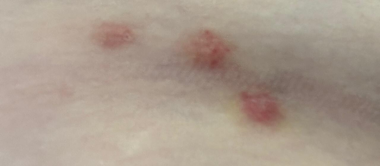 classic grouping of bed bugs, 3 in a row