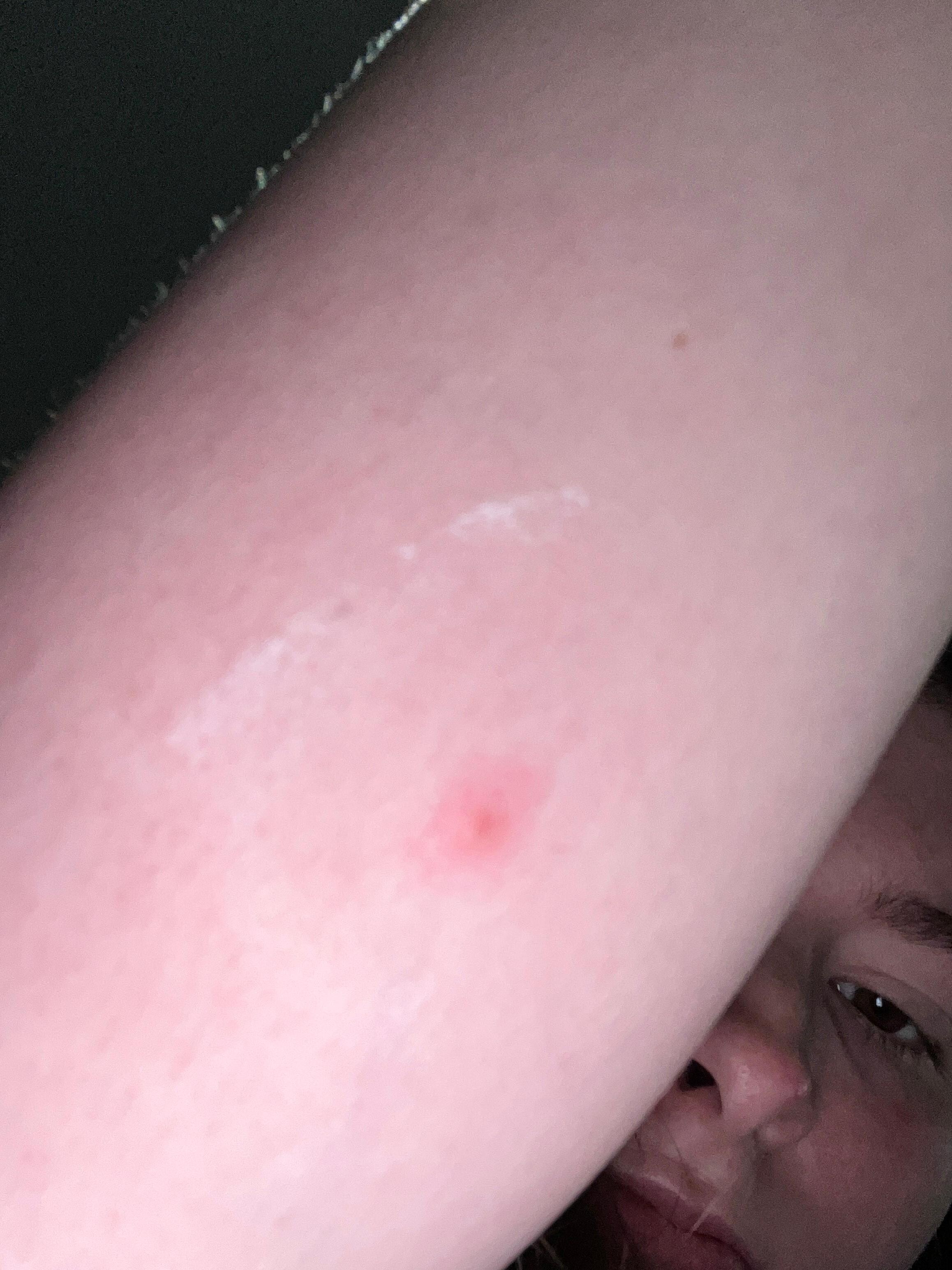Another bite on my arm. 