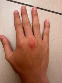This is what the mosquitos did to my daughters all over their bodies.