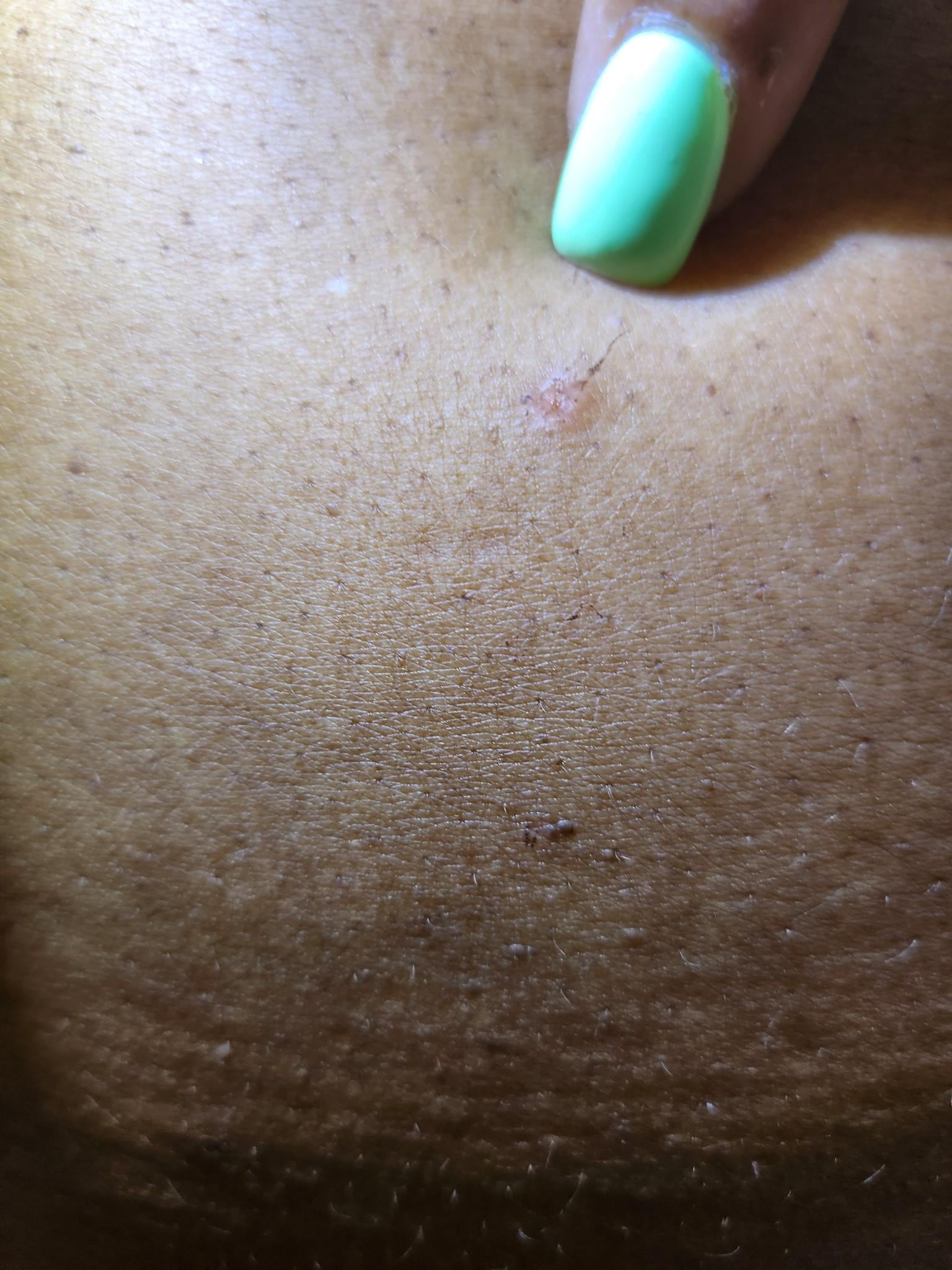 Bed Bug Be te
