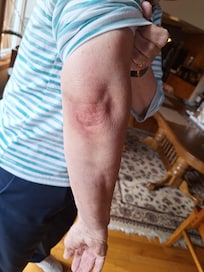 The bruised elbow