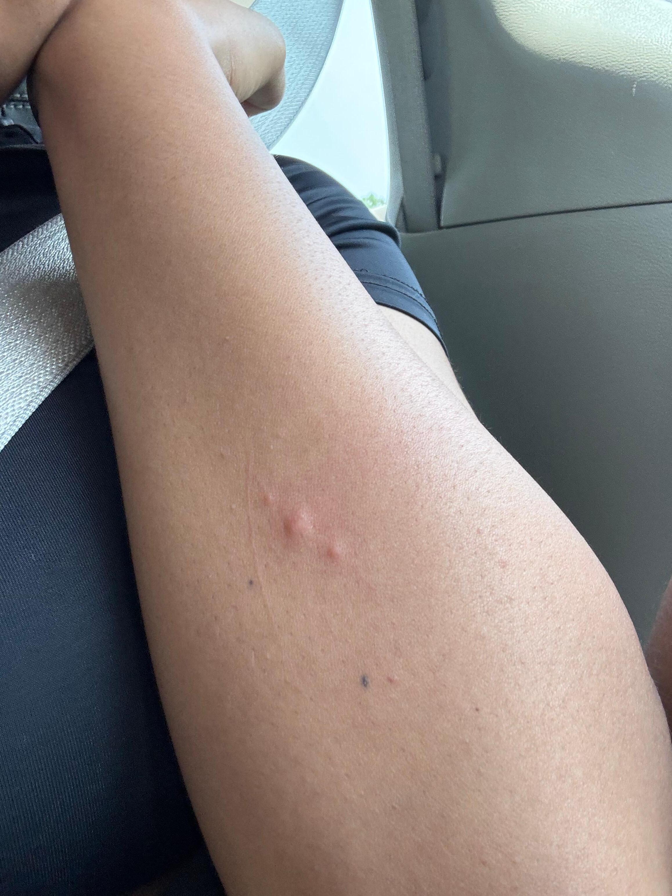 Bed bug bites arm