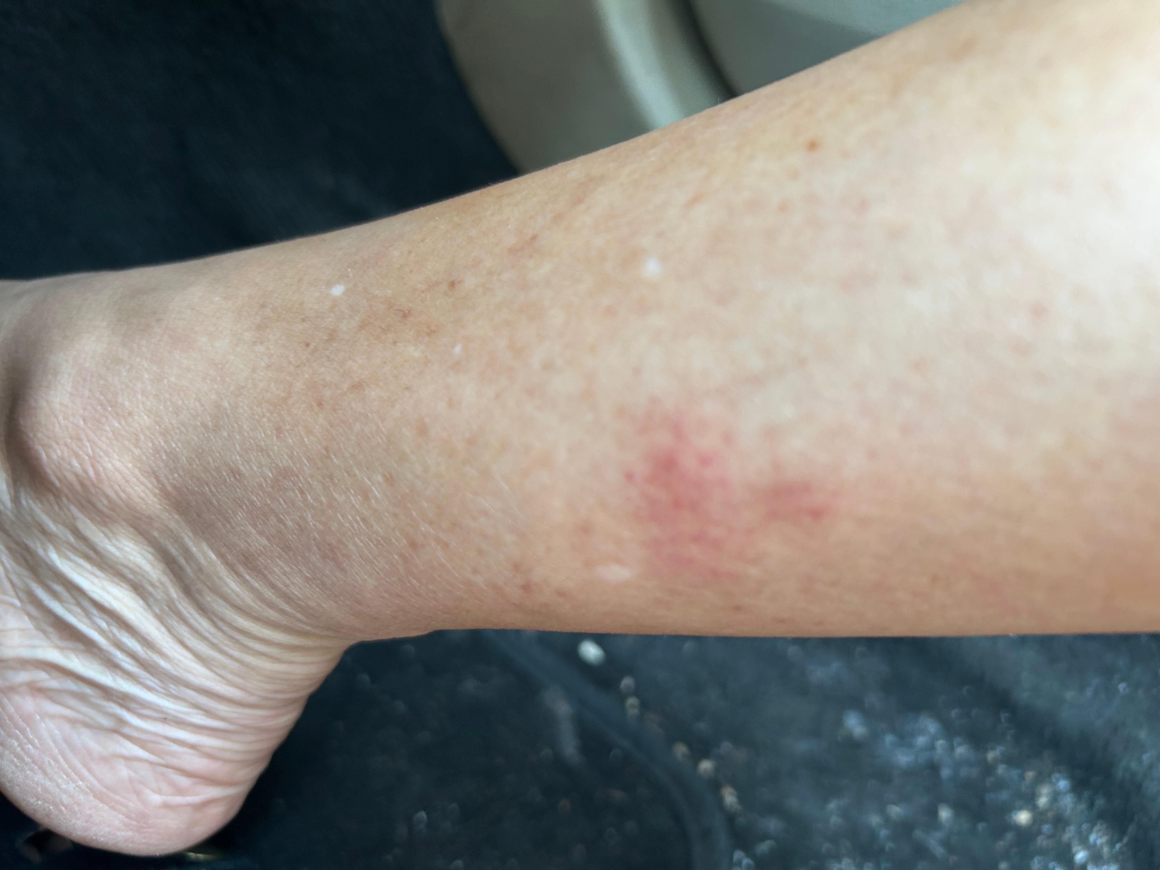 Bites