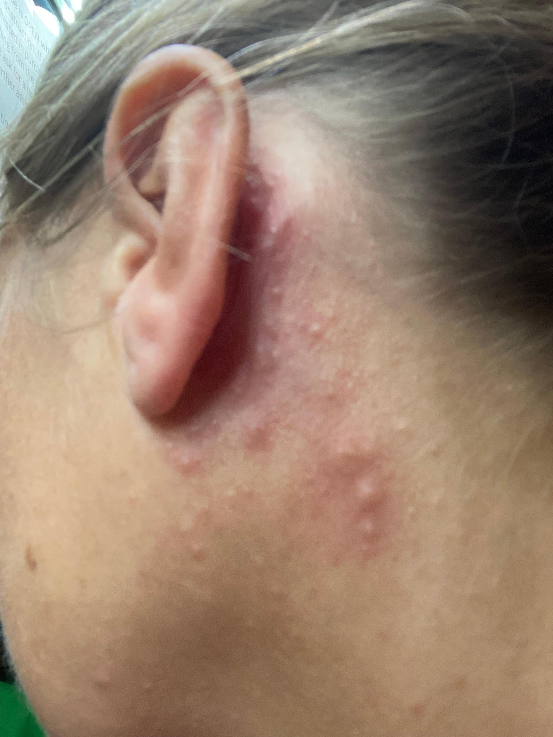 BED BUGS! 