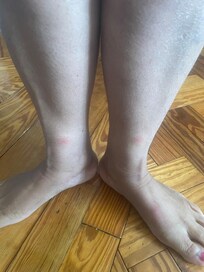 Bed bug bites